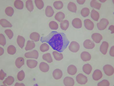 atypical lymphocyte ebv